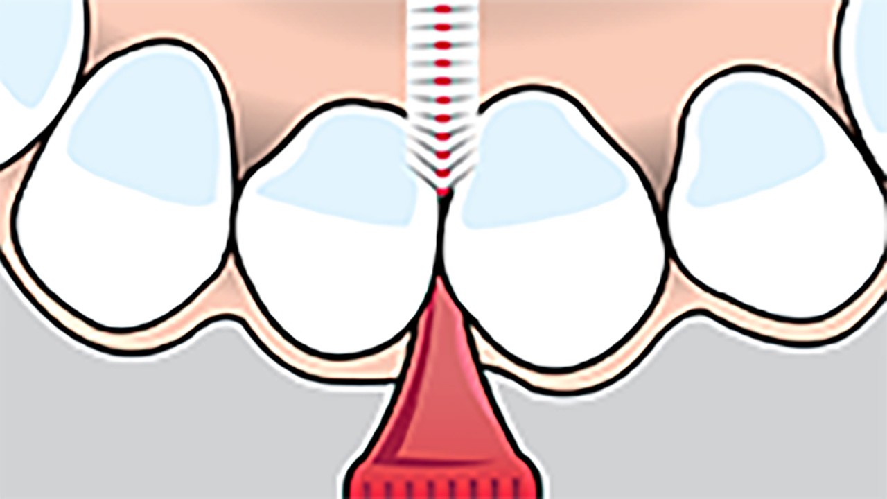 interdentalbuerste -anwendung-schneidezahn-2.jpg