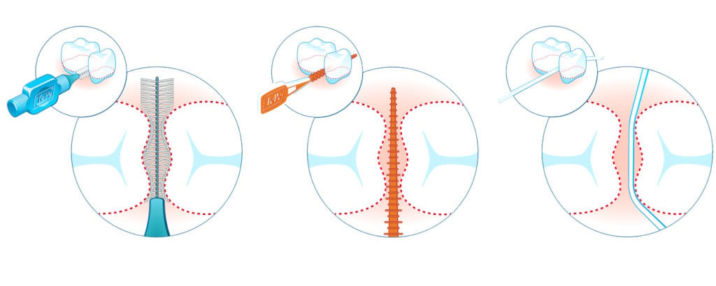 Zwischenraumreinigung mit Interdentalbürste, Zahnstick oder Zahnseide